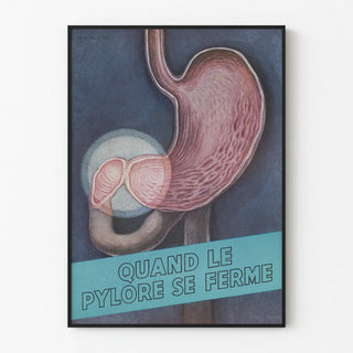 quand-le-pylore-se-ferme