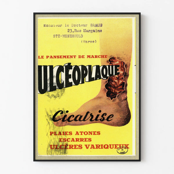 ulceoplaque